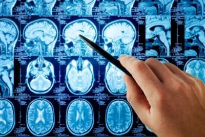 Lawyer for TBI from Auto Accidents in Greenville, South Carolina